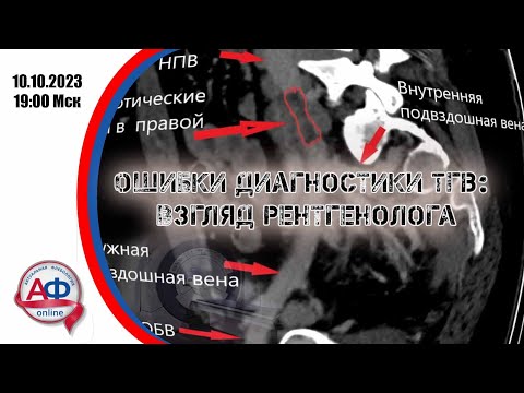 Видео: Ошибки диагностики тромбоза глубоких вен: взгляд рентгенолога