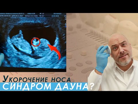 Видео: КАК ПОНЯТЬ НА УЗИ есть ли риски хромосомных аномалий у детеныша на сроке 11-14 недель?