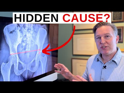 Видео: Этот дисбаланс может привести к пожизненным болям в спине и крестцово-подвздошном суставе.