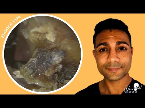 Видео: 1375 - Удаление темной корки омертвевшей кожи из ушей и пробок (наждачная бумага)