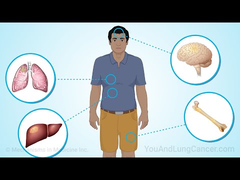 Видео: Понимание мелкоклеточного рака лёгких — обновлено в 2025 г.