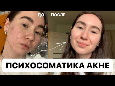Видео: Психосоматика АКНЕ | личный опыт