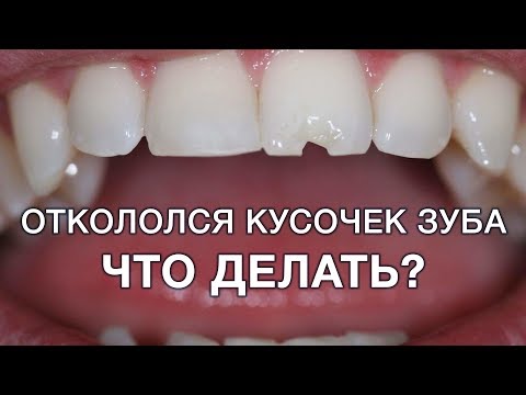 Видео: Что делать если откололся кусок зуба?