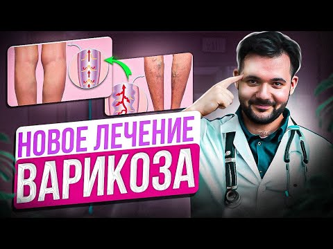 Видео: Избавься от ВАРИКОЗА навсегда. ВСЯ ПРАВДА ИЗ-ЗА ЧЕГО ОН ПОЯВЛЯЕТСЯ и КАК ЕГО ЛЕЧИТЬ!