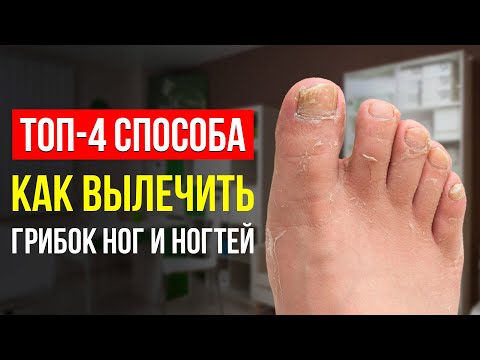 Видео: КАК ИЗБАВИТЬСЯ ОТ ГРИБКА НОГ И НОГТЕЙ? ГЛАВНЫЕ СОВЕТЫ, КАК ВЫЛЕЧИТЬ ГРИБОК (ЗНАЕТ ТОЛЬКО 1%)