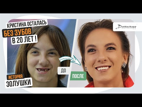 Видео: Кристина осталась БЕЗ ЗУБОВ в 20 лет! → Дантистофф #зубныепротезы #имплантациязубов