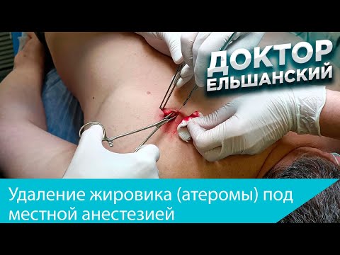 Видео: Удаление жировика атеромы спины под местной анестезией