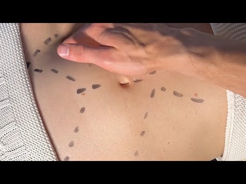 Видео: Как начать ровнять таз. Спайки. ППМ. Ножки диафрагмы.