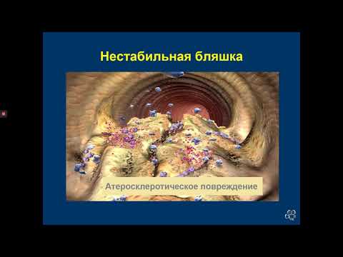 Видео: Острый коронарный синдром