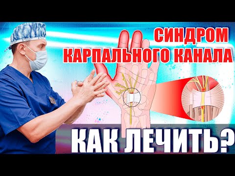 Видео: Синдром карпального канала - правильное лечение!