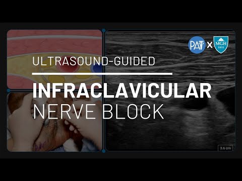 Видео: Блокада подключичного нерва // Демонстрация под ультразвуковым контролем