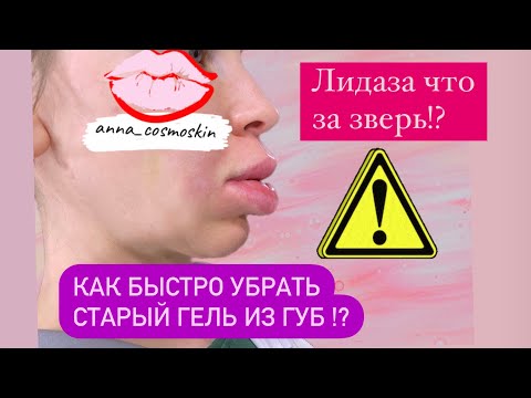 Видео: Как убрать старый гель из губ ! Лидаза , лонгидаза отличия ! Процедура в эфире !