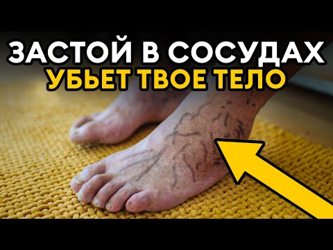 Видео: Тромбы в ногах развиваются НЕЗАМЕТНО! Вот что нужно сделать сейчас, чтобы СПАСТИ сердце и сосуды!