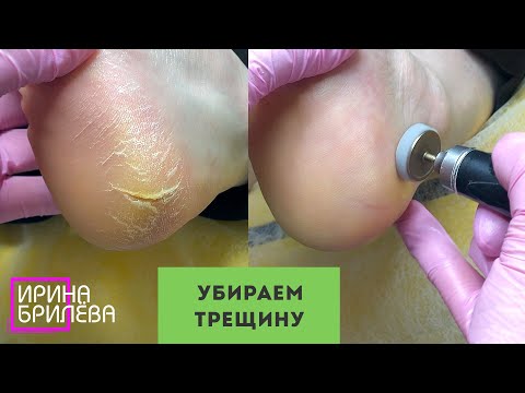 Видео: Глубокая ТРЕЩИНА НА ПЯТКЕ 🌸 Педикюр 🌸 Ирина Брилёва