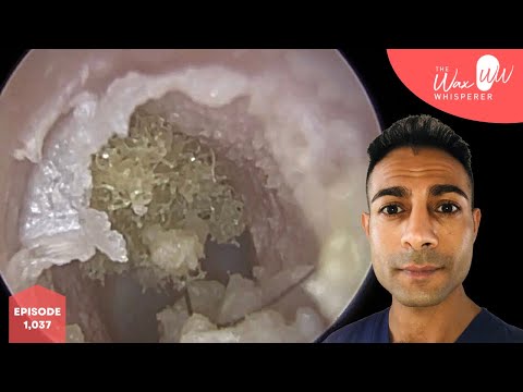 Видео: 1037 - Грибковая инфекция уха, вызванная Aspergillus niger (отомикоз)