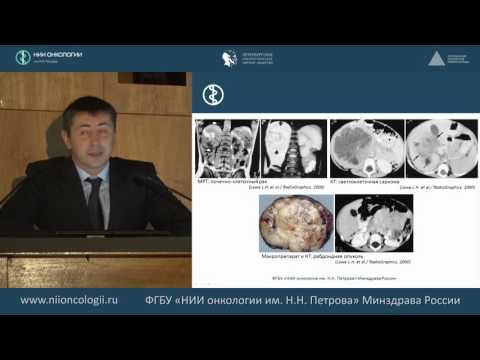 Видео: «Лучевая диагностика опухоли Вилмса» (УЗИ, КТ\МРТ, диф.диагноз, нефробластоматоз)