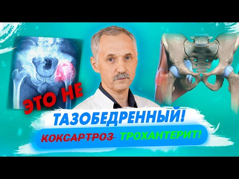 Видео: Лечим  тазобедренный сустав и нет эффекта? Возможно, это трохантерит / Доктор Виктор