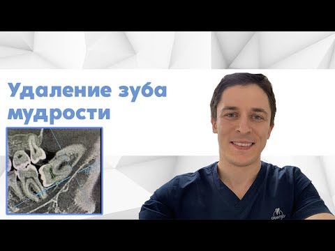 Видео: Квалифицированное удаление восьмого зуба мудрости.
