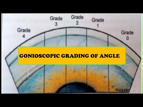 Видео: #7 Гониоскопия | Системы оценки и схематическое изображение