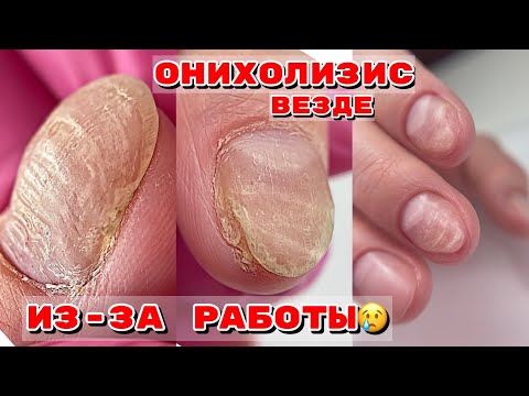 Видео: ОНИХОЛИЗИС на всех ногтях 😒 Убила работой ногти 😒 Маникюр на клиенте