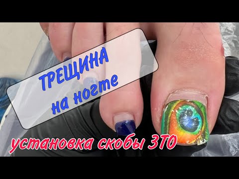 Видео: 📌БОЛИТ палец / 💥мозоли под ногтем / 👩‍⚕️подология / 🔱скоба для ногтей