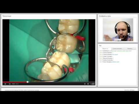 Видео: 2015 12 01 Композитная реставрация боковых зубов  Клинические примеры