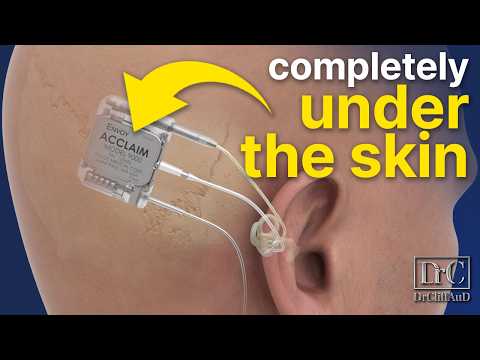 Видео: 100% невидимый кохлеарный имплант | Одобрено Envoy Medical