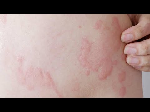Видео: АЛЛЕРГИЯ: поллиноз и крапивница