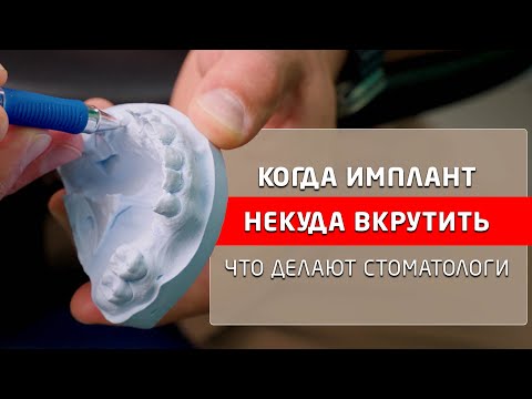 Видео: Костная пластика нижней челюсти и синус-лифтинг, зачем стоматологи делают это.