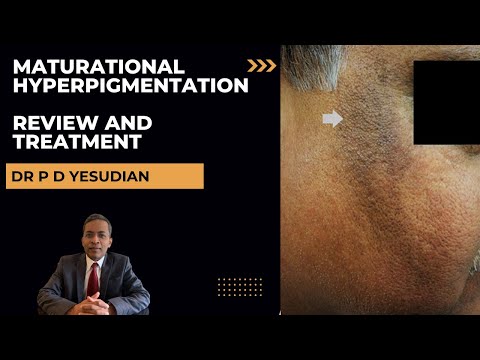 Видео: Темные пятна на щеках? Возрастная гиперпигментация — обзор и лечение