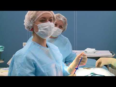Видео: Возможность говорить после удаления гортани есть