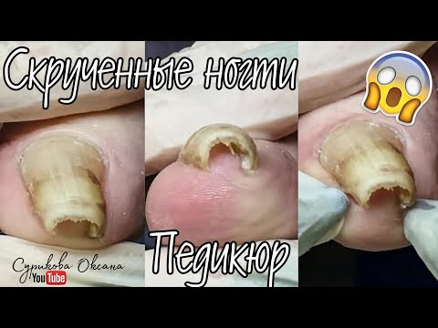Видео: Скрученные ногти на ногах. Классический педикюр, обработка пальцев ног. Покрытие лаком Kinetics