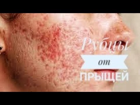 Видео: Рубцы и шрамы после прыщей. Как убрать рубцы постакне?