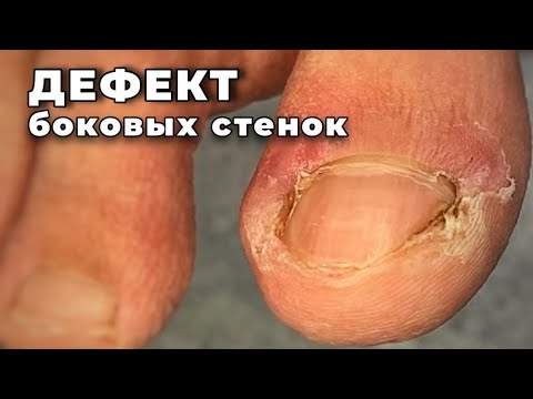 Видео: Осознанно режет боковины чтобы не давило. Глубокое врастание и давление