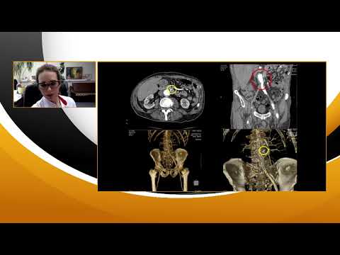 Видео: 1. Чупаленкова О.А., Коржева И.Ю. Аорто-дуоденальная фистула- редкий источник рецидивирующего ЖКК.