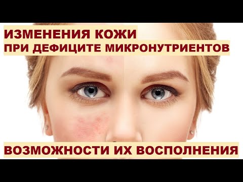 Видео: Чернова Н.И. Изменения кожи при дефиците микронутриентов и возможности их восполнения