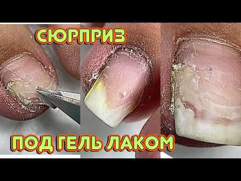 Видео: Сюрприз под гель лаком  😕 Отошел ноготь / Педикюр