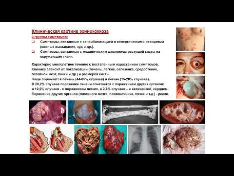 Видео: УЗИ. Доктор Иогансен. Выпуск 19. Эхинококковые поражения печени. Часть 1.
