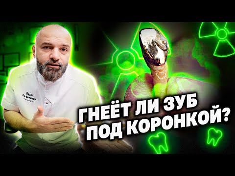 Видео: Как выбрать ЗУБУЮ КОРОНКУ, чтобы не сгнил зуб? Металлокерамика или Цирконий