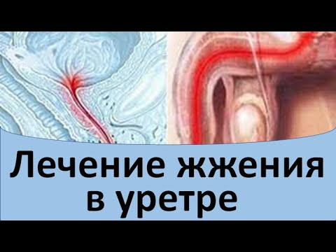 Видео: Лечение жжения в уретре