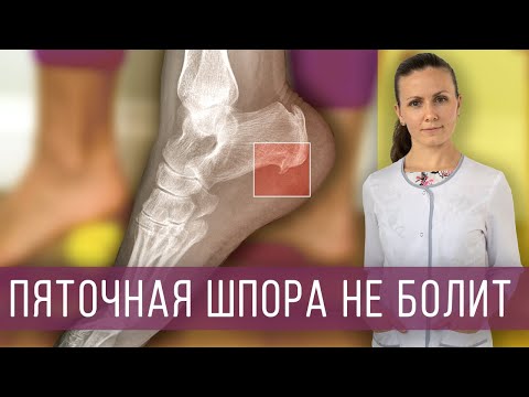 Видео: Боль в пятке: пяточная шпора, плантарный фасциит. Причины, симптомы, как лечить.