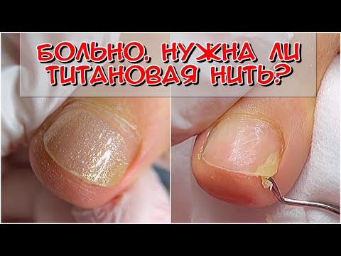 Видео: Нужна титановая нить? / Скрученный ноготь / Размягчающее средство для ногтевых пластин от DOMIX