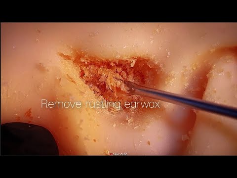 Видео: ASMR Удаляет шелест ушной серы❤️ Visual Tingle★ Чистый звук★ *No talking*