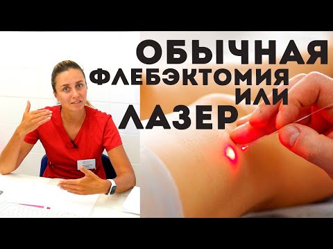 Видео: Удаление ВАРИКОЗА. Лазер или обычное удаление вен?