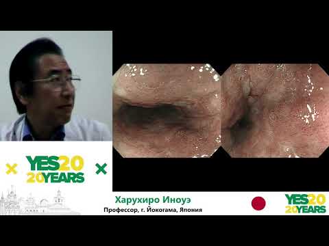 Видео: 11. Неоплазия пищевода - плоскоклеточный рак. Харухиро Иноуэ