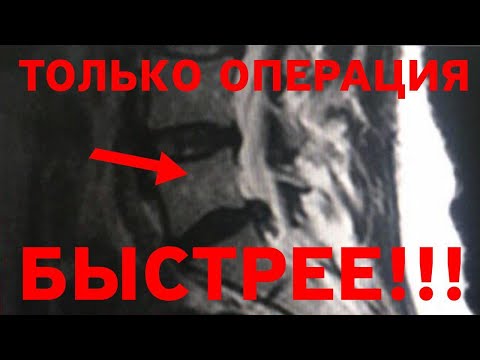 Видео: Мучительный прострел в пояснице. Срочно оперировать эту грыжу!