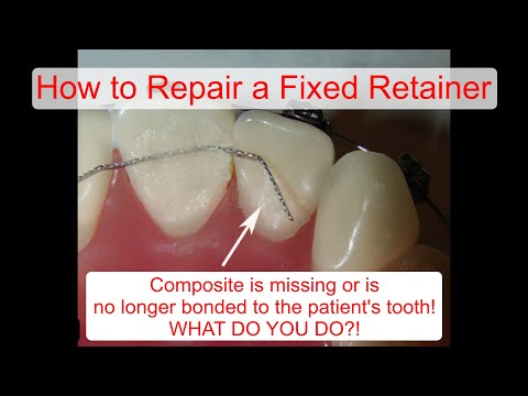 Видео: Как отремонтировать несъемный ретейнер