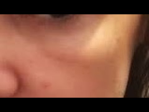 Видео: Малярные мешки. Аптечное средство и упражнения от малярных мешков.