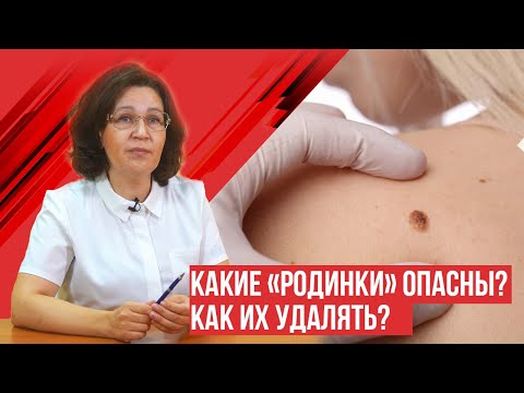 Видео: Какие родинки нужно удалять и как?