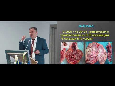 Видео: Нефрэктомия и тромбэктомия при опухолевом тромбозе нижней полой вены. Атдуев В.А. (Казань)